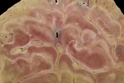 TOP! A+++ Solenopora ( Algue bleue) - Kimmeridgien - Charente Maritime, FRANCE